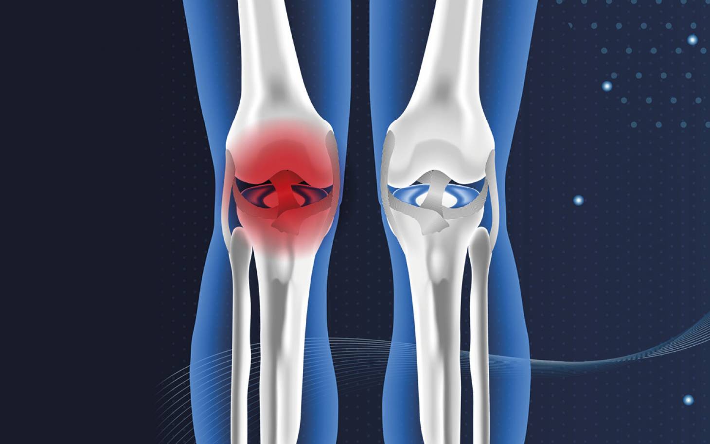 Courir, c'est protéger ses cartilages