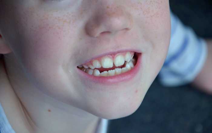 Soins : les enfants serrent les dents