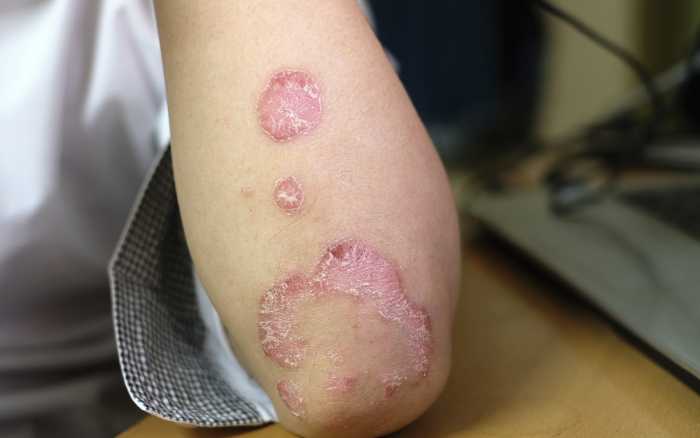 Psoriasis, au-delà de la peau